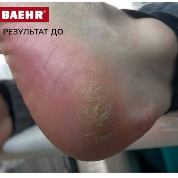 Мазь от трещин с экстрактом эхинацеи 30мл (SCHRUNDENSALBE), PEDIBAEHR (10803 10803 фото